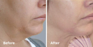 InMode 鈥 Forma Plus