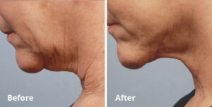 InMode 鈥 Forma Plus