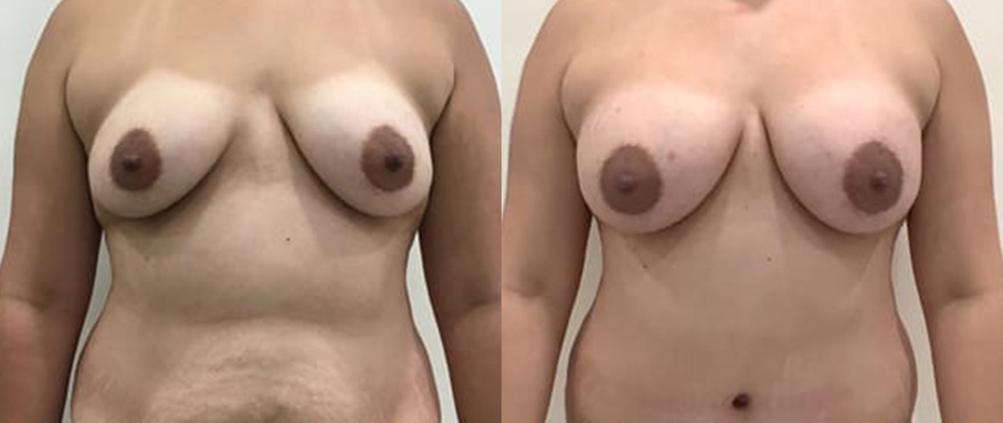 Breast Augmentation Before and Arter