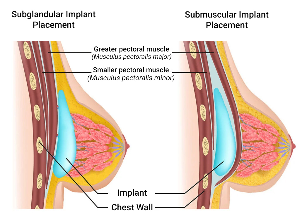 Breast Implant Placement Options