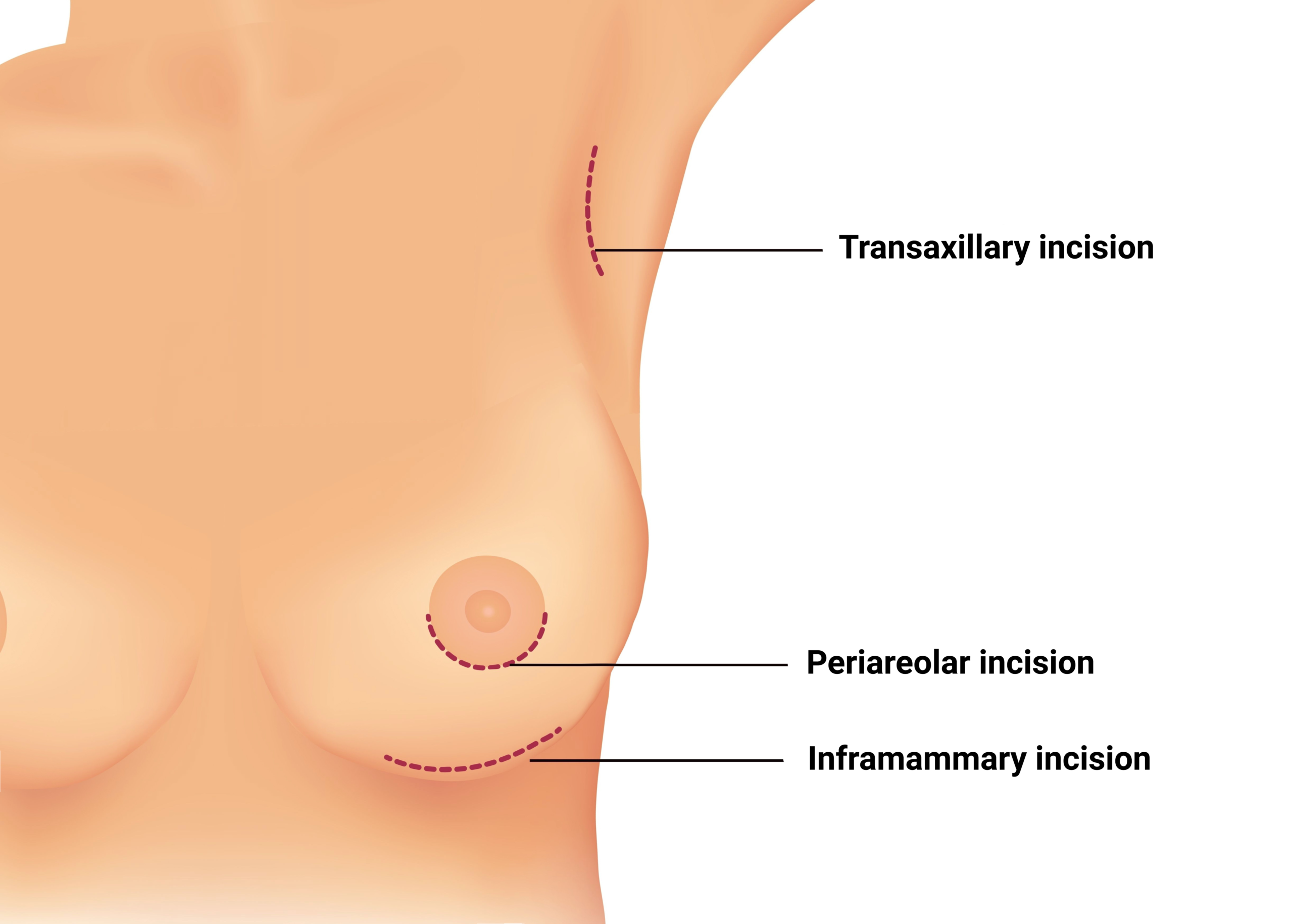 Breast Augmentation Incision Options