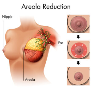 areola reduction
