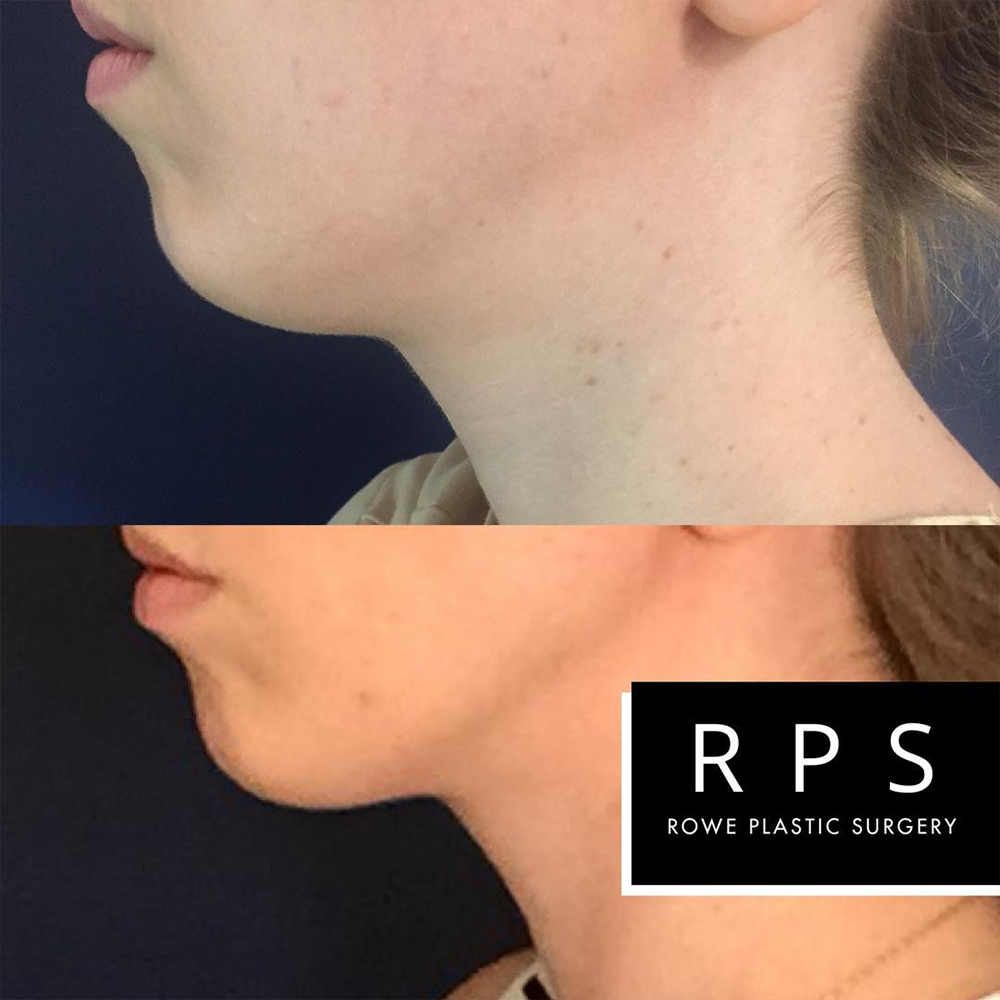 ultherapy before after