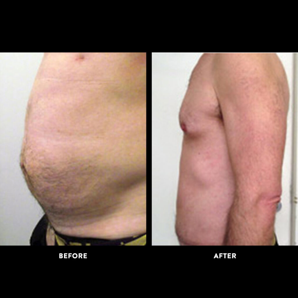 tummy tuck surgery before and after