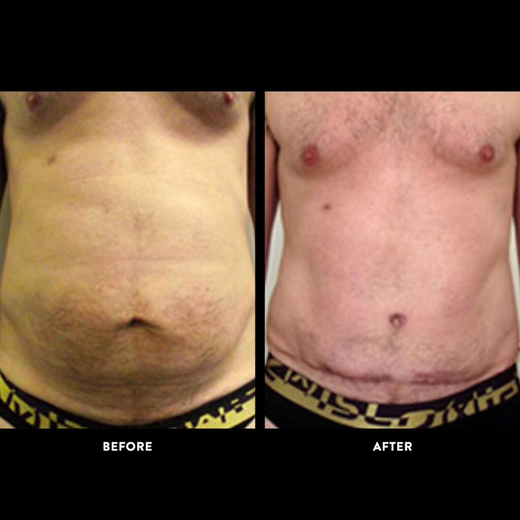 before after abdominopplasty