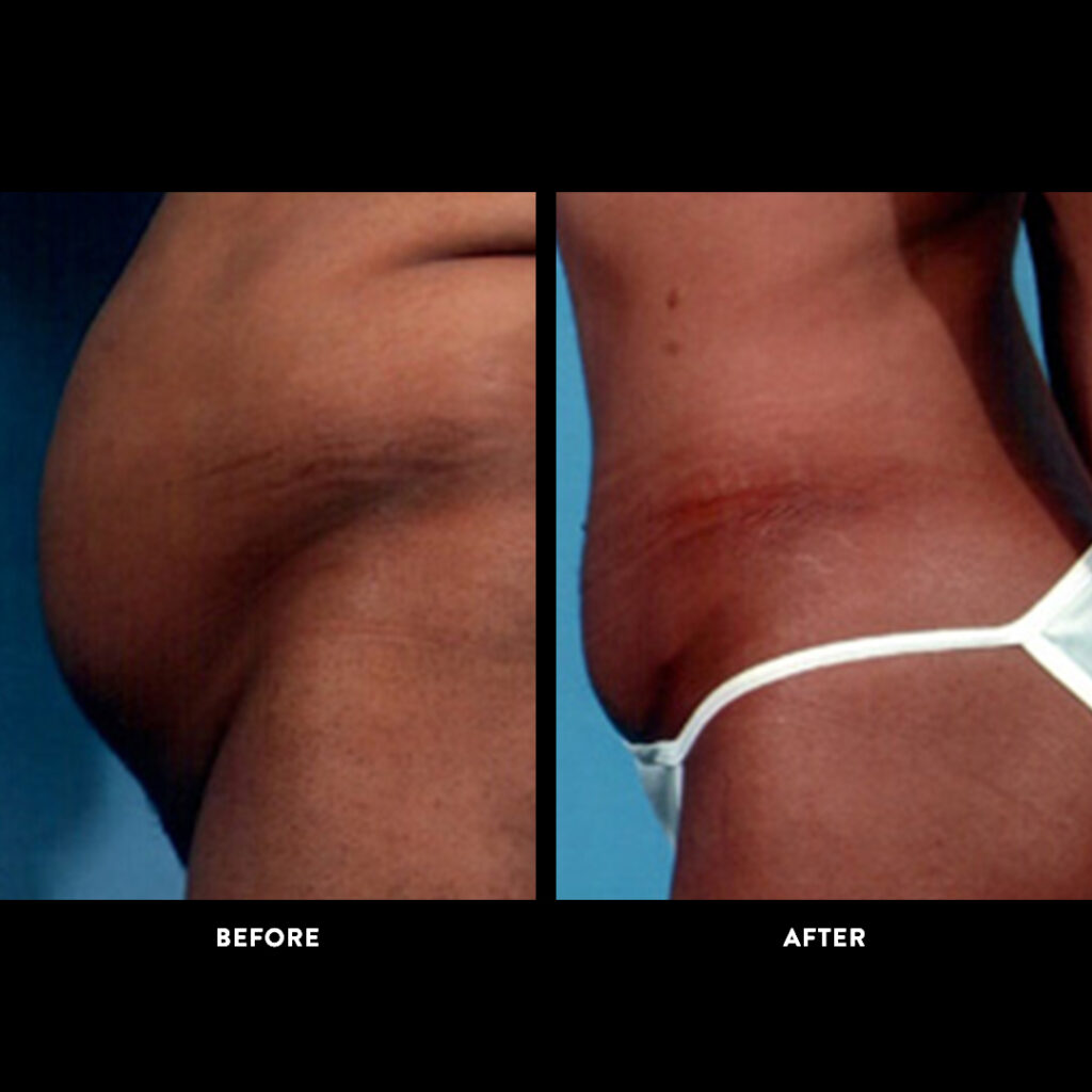 abdominoplasty before and after