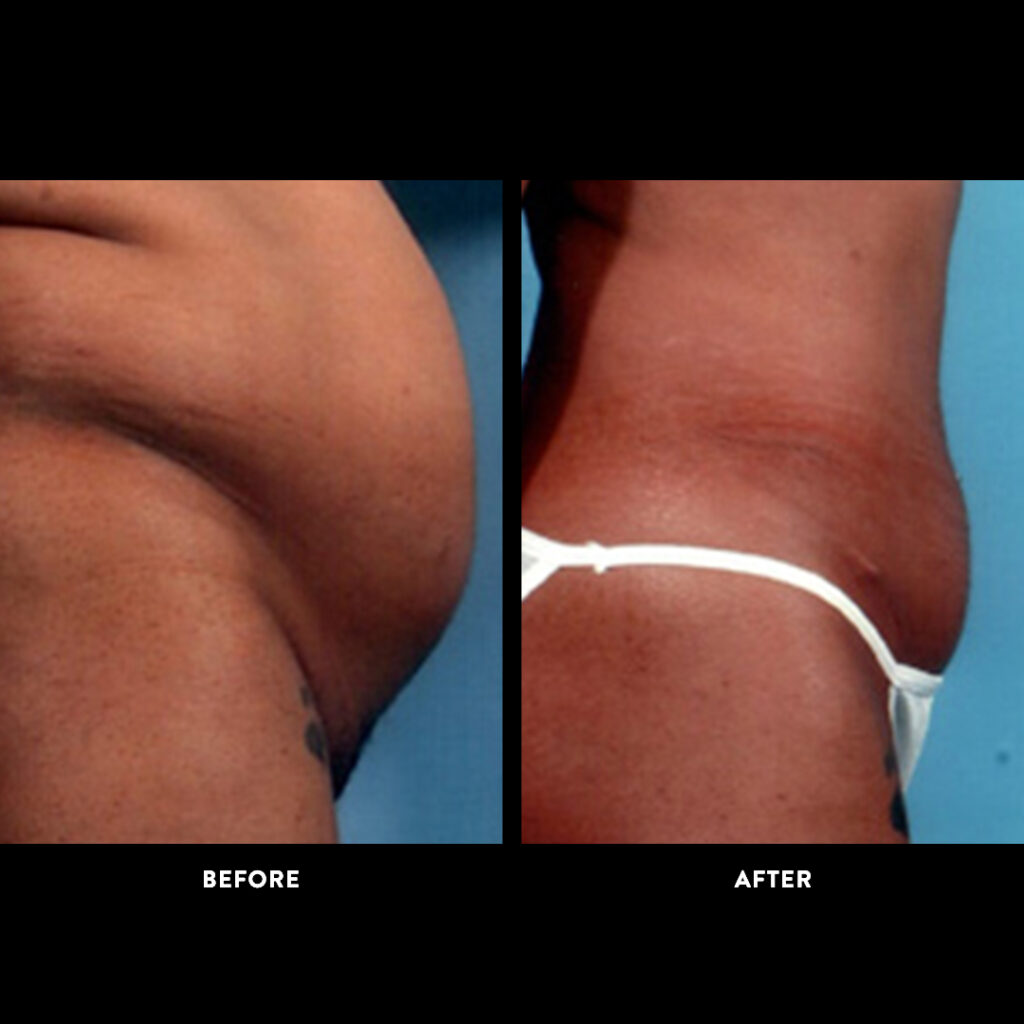 tummy tuck before and after