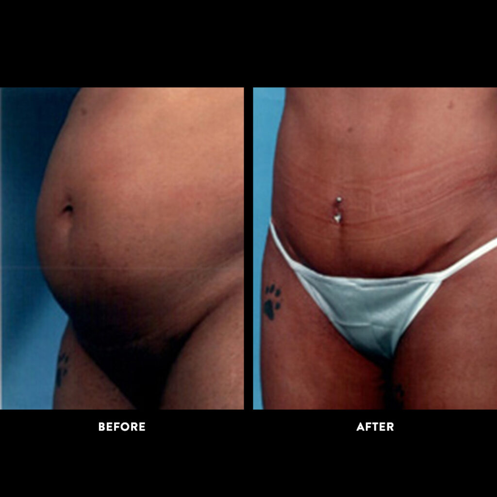 abdominoplasty before and after photo