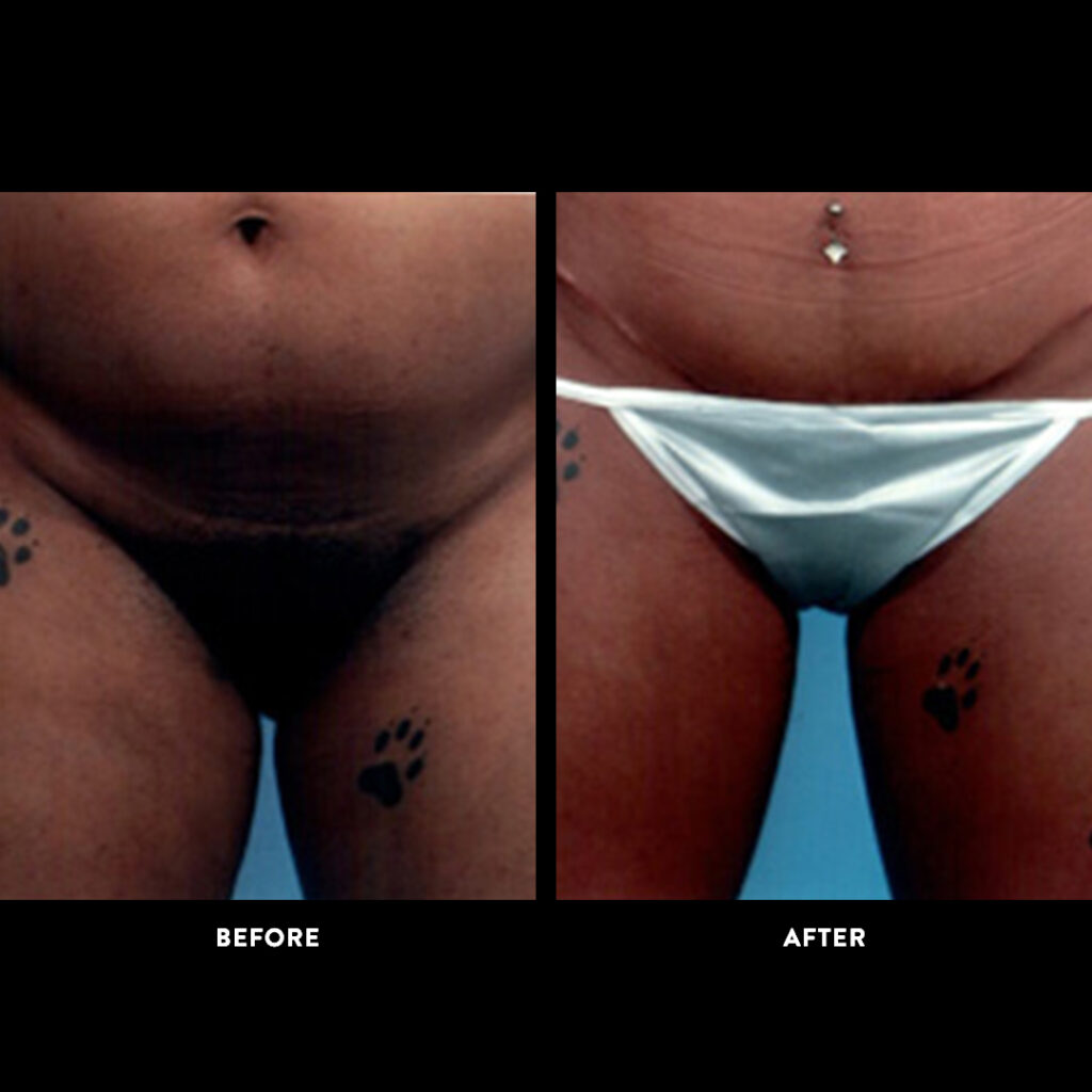 tummy tuck before and after photo