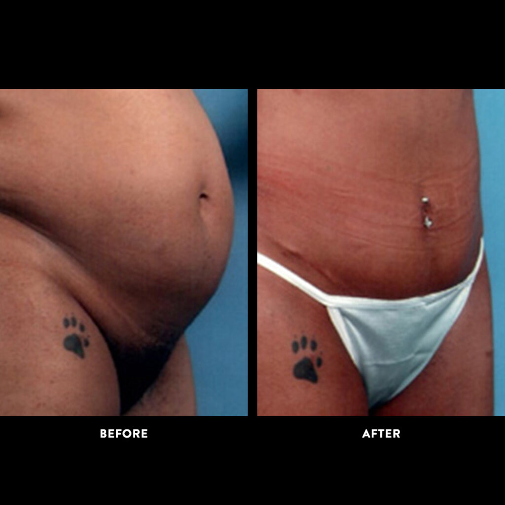 tummy tuck before and after picture