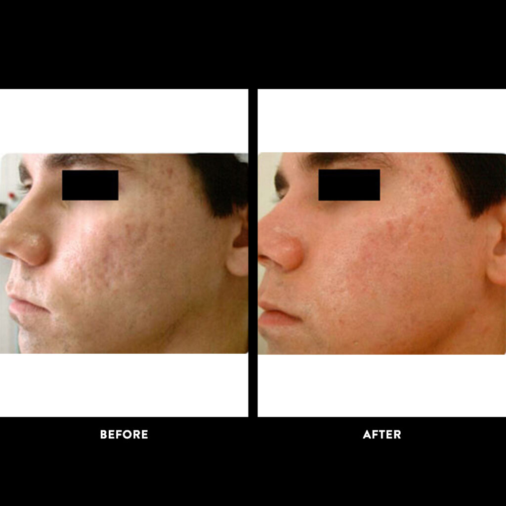 acne treatment before and after