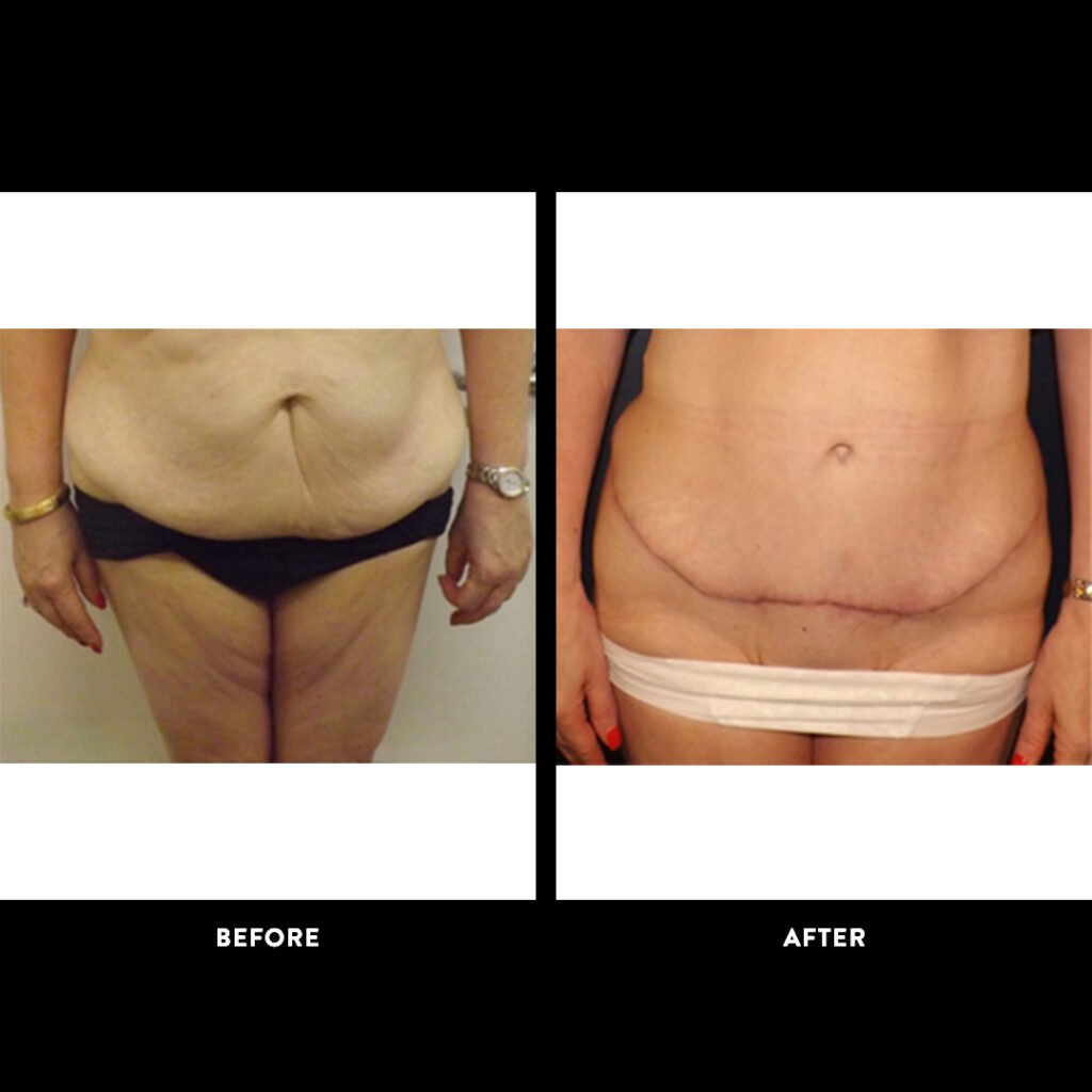 before after tummy tuck