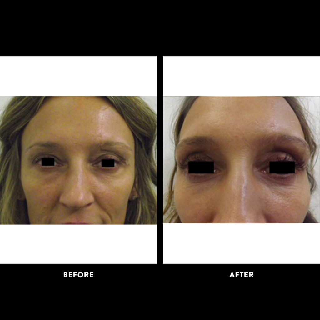 Blepharoplasty before and after
