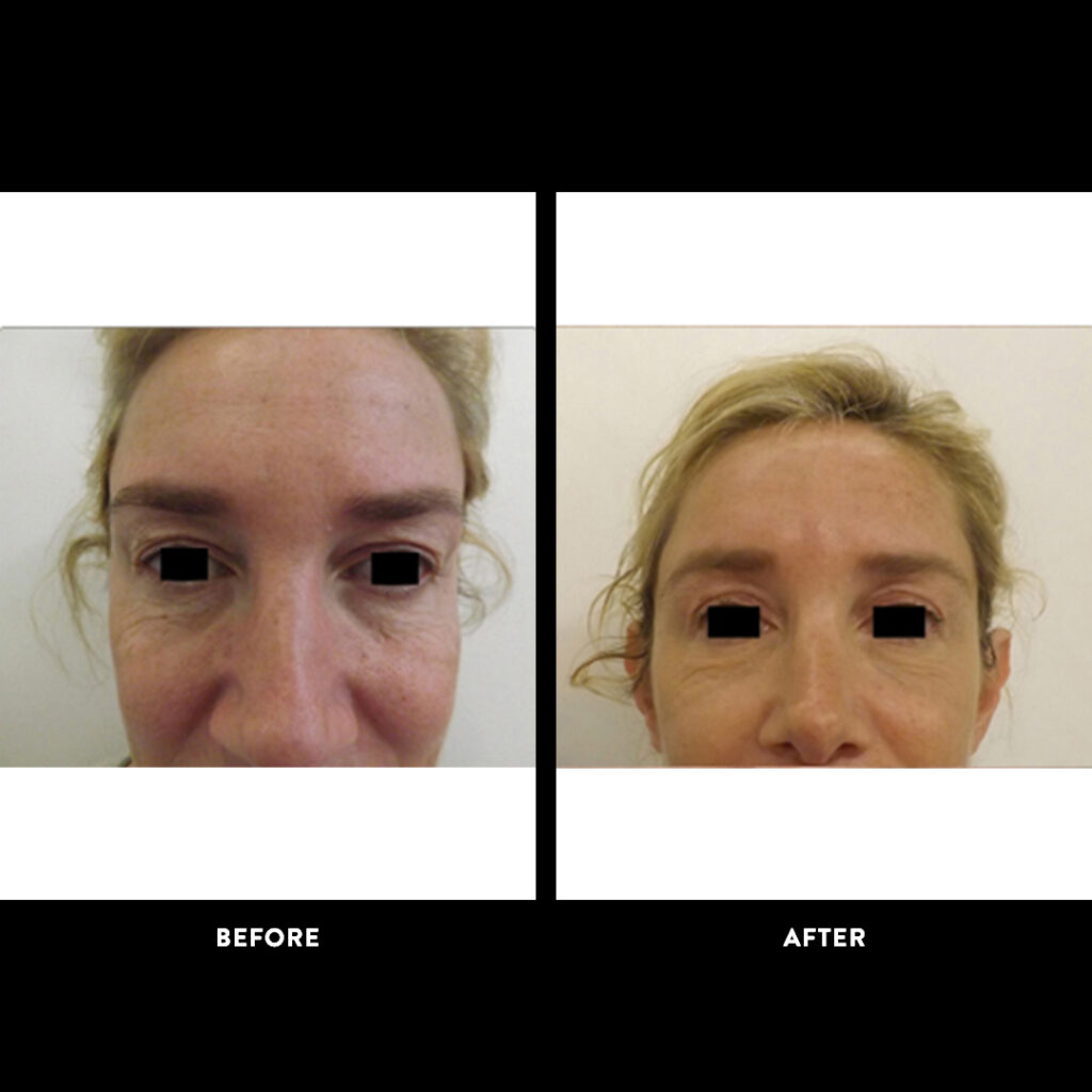Blepharoplasty before and after photo