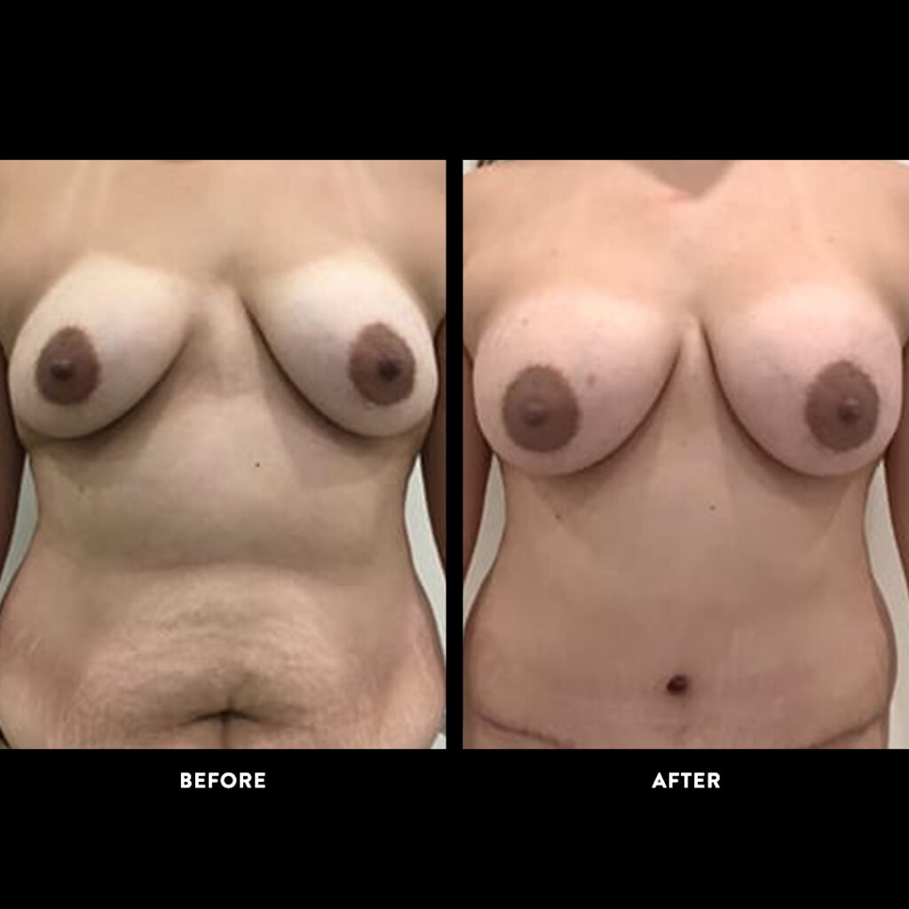 breast augmentation before & after