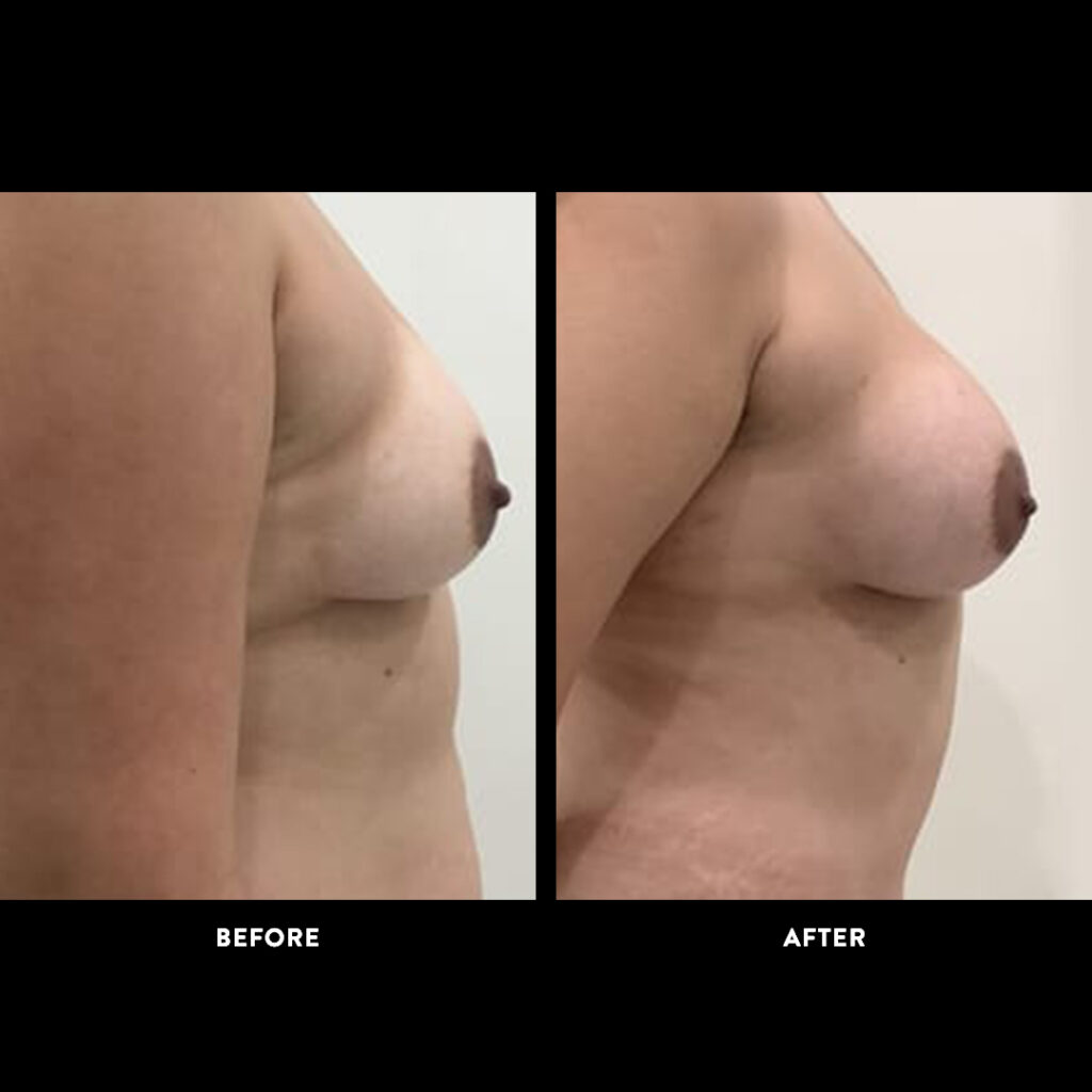 breast augmentation before & after picture