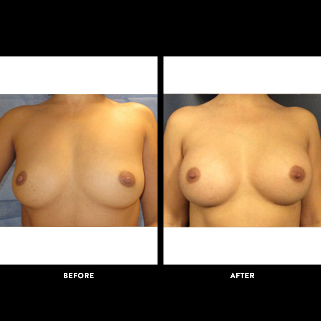 breast augmentation before & after photo