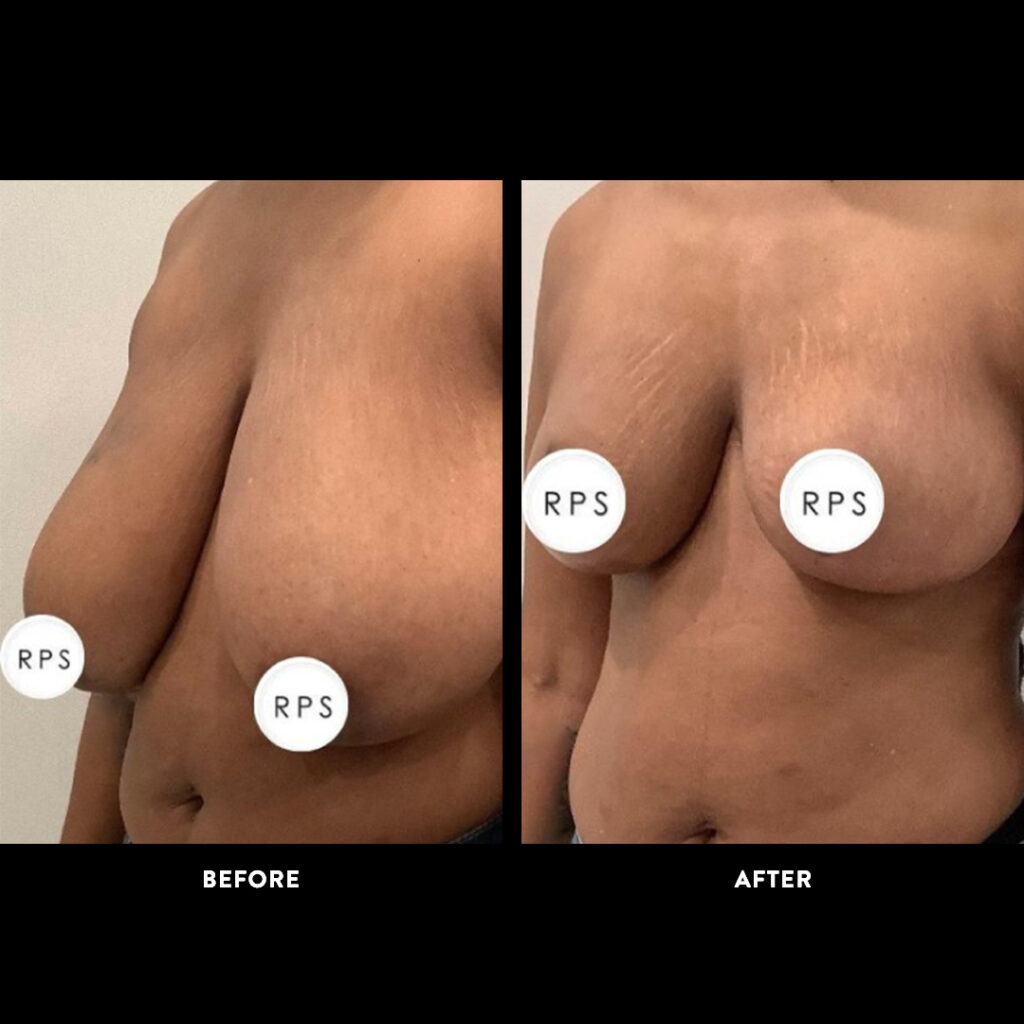 mammaplasty before and after
