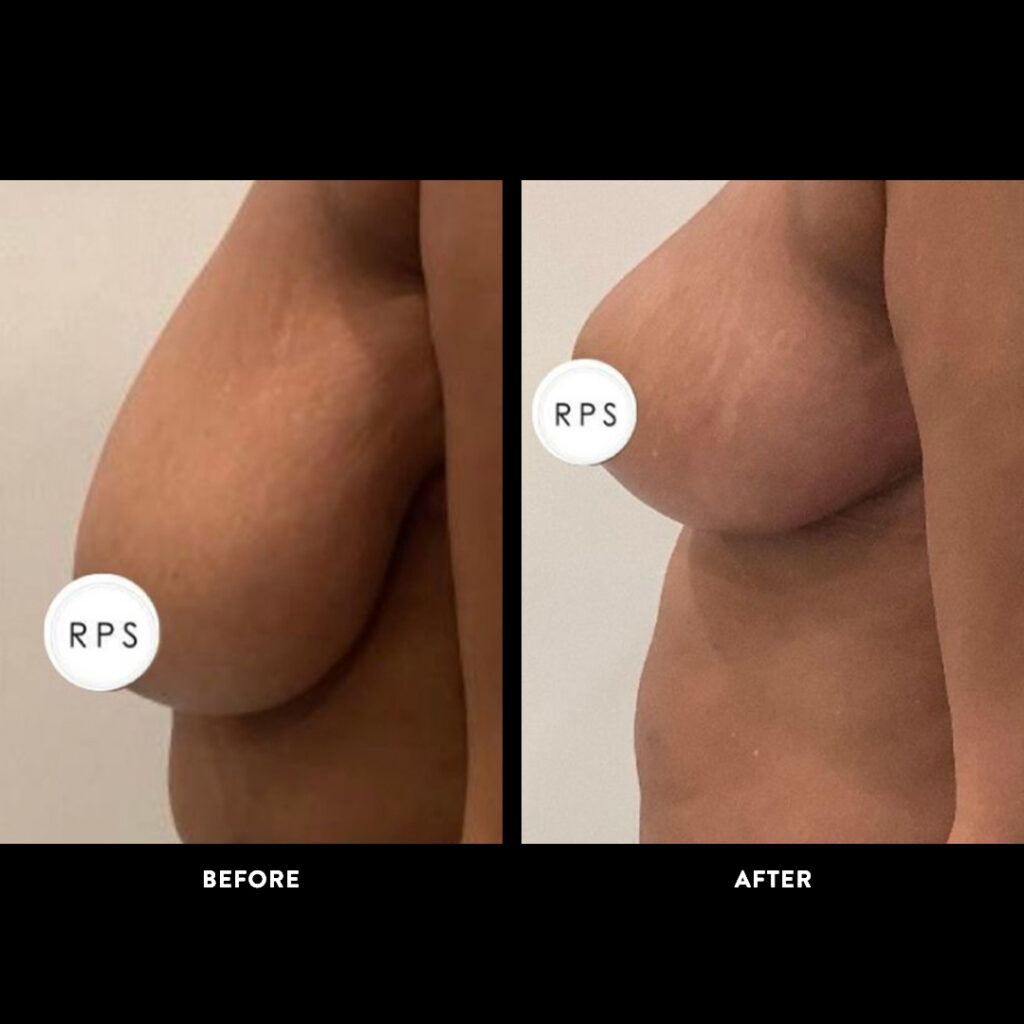 Breast Reduction surgical procedure before & after 2