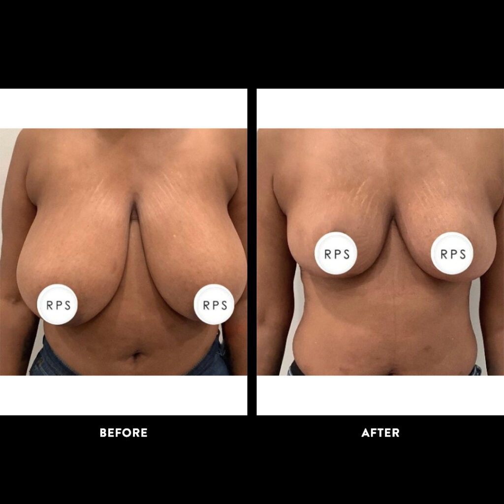 Breast Reduction surgical procedure before and after 2