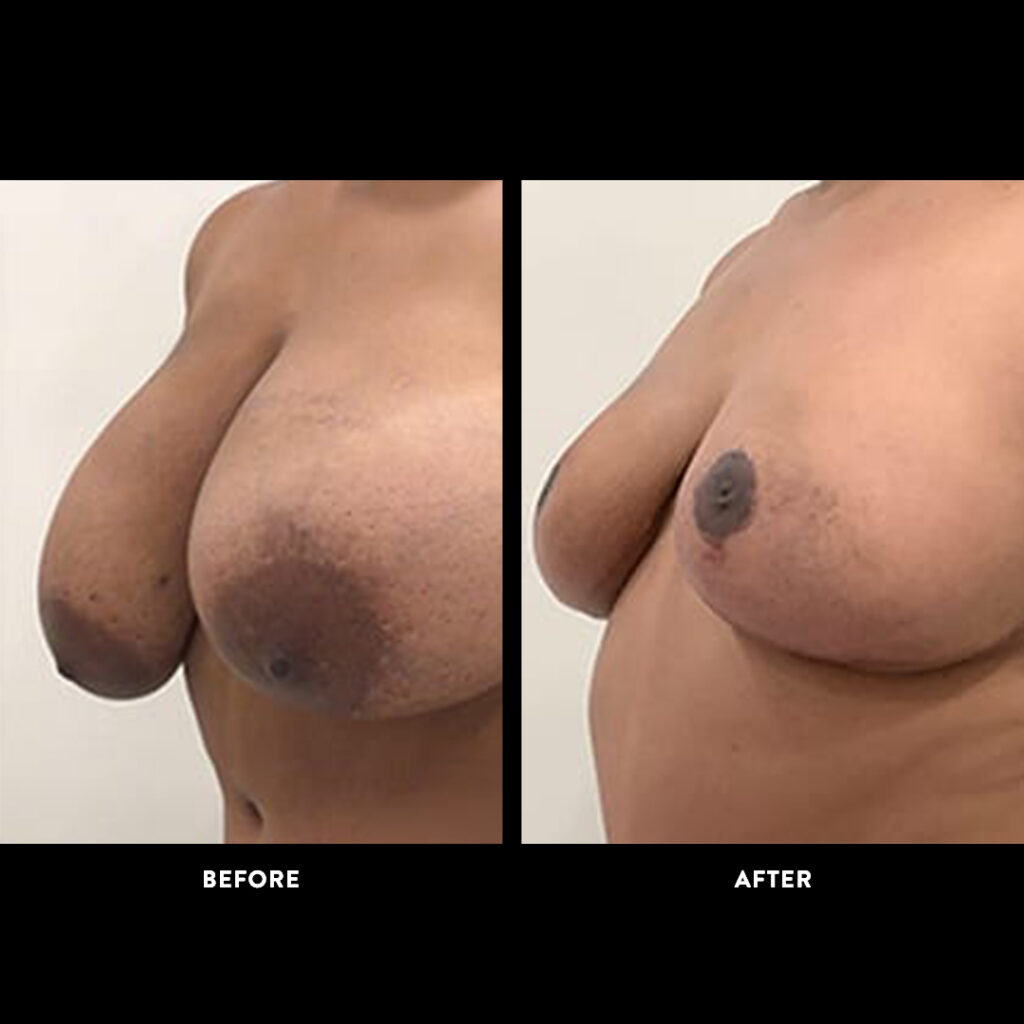 mammaplasty surgery before and after picture