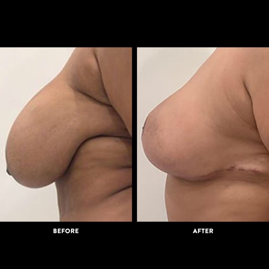 mammaplasty before and after picture