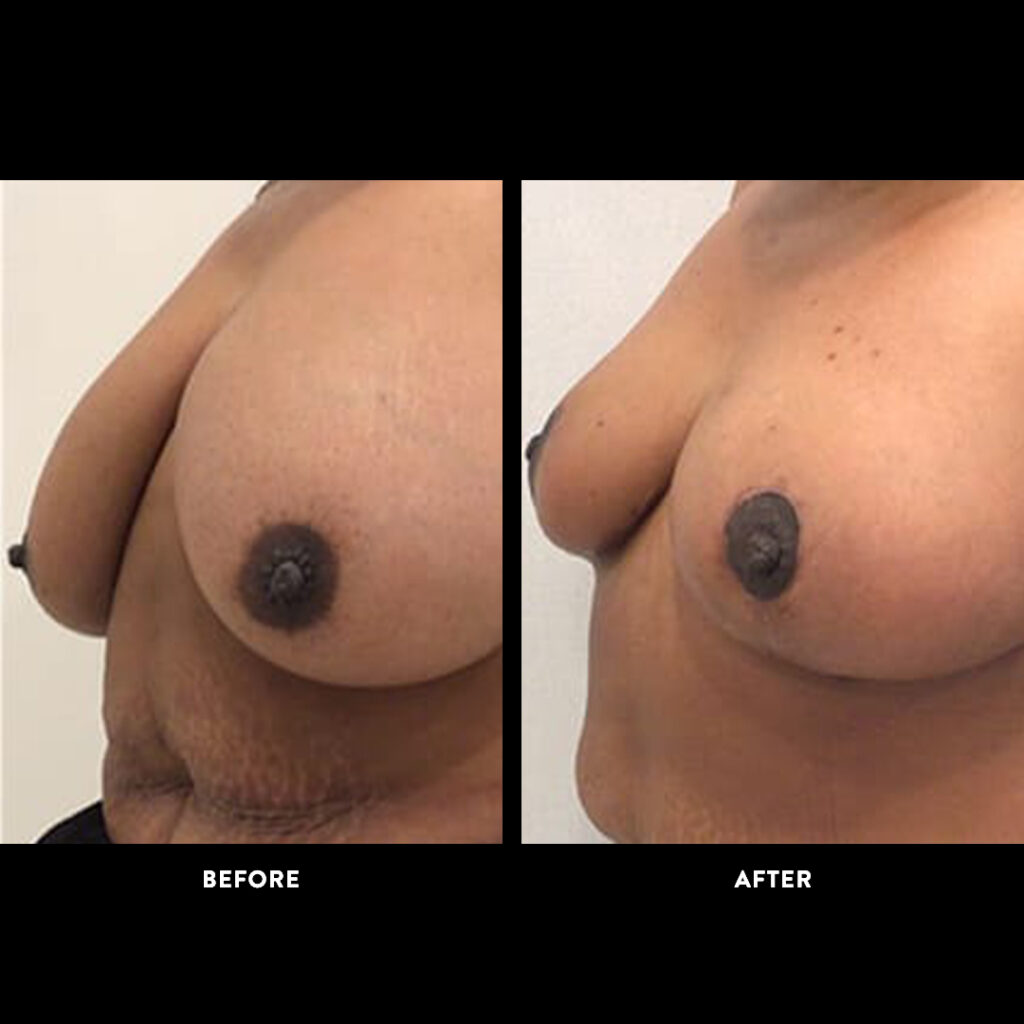 mammaplasty surgery before and after