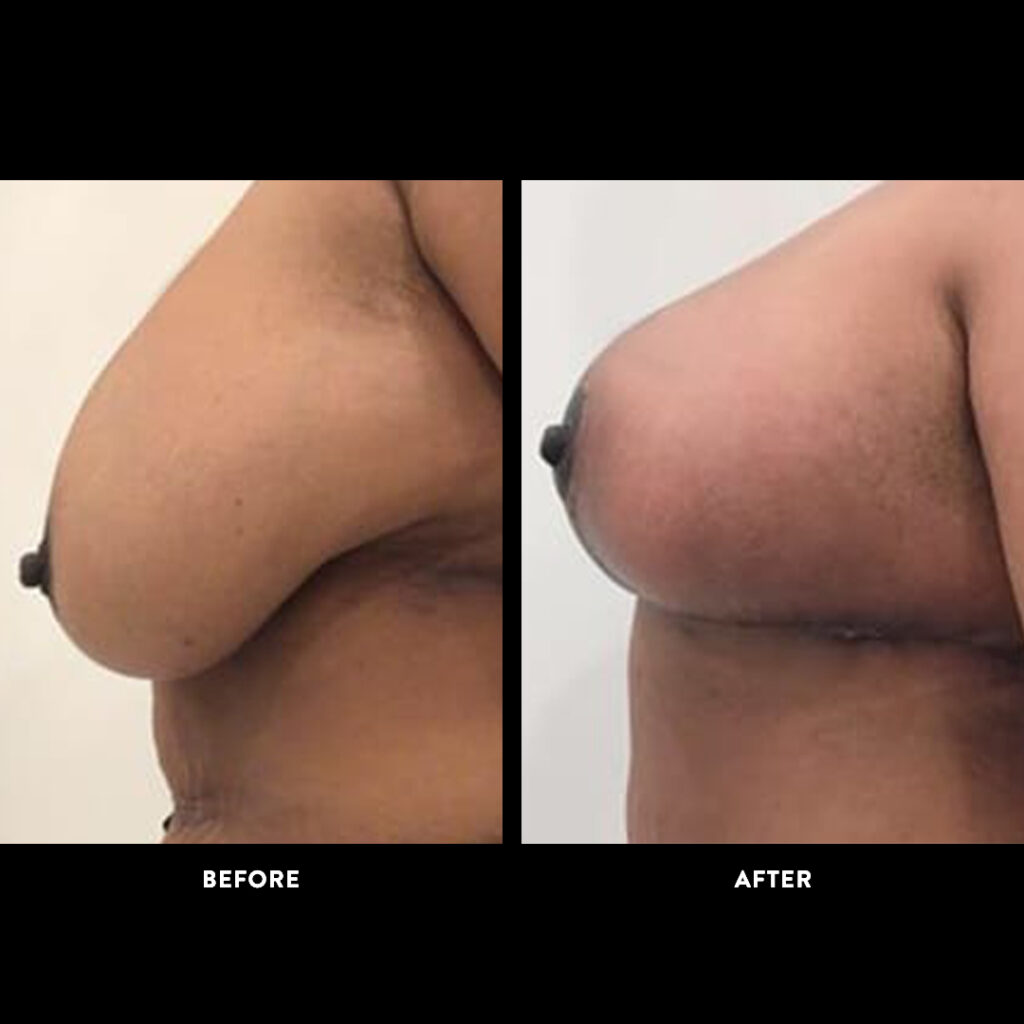mammaplasty procedure before and after picture