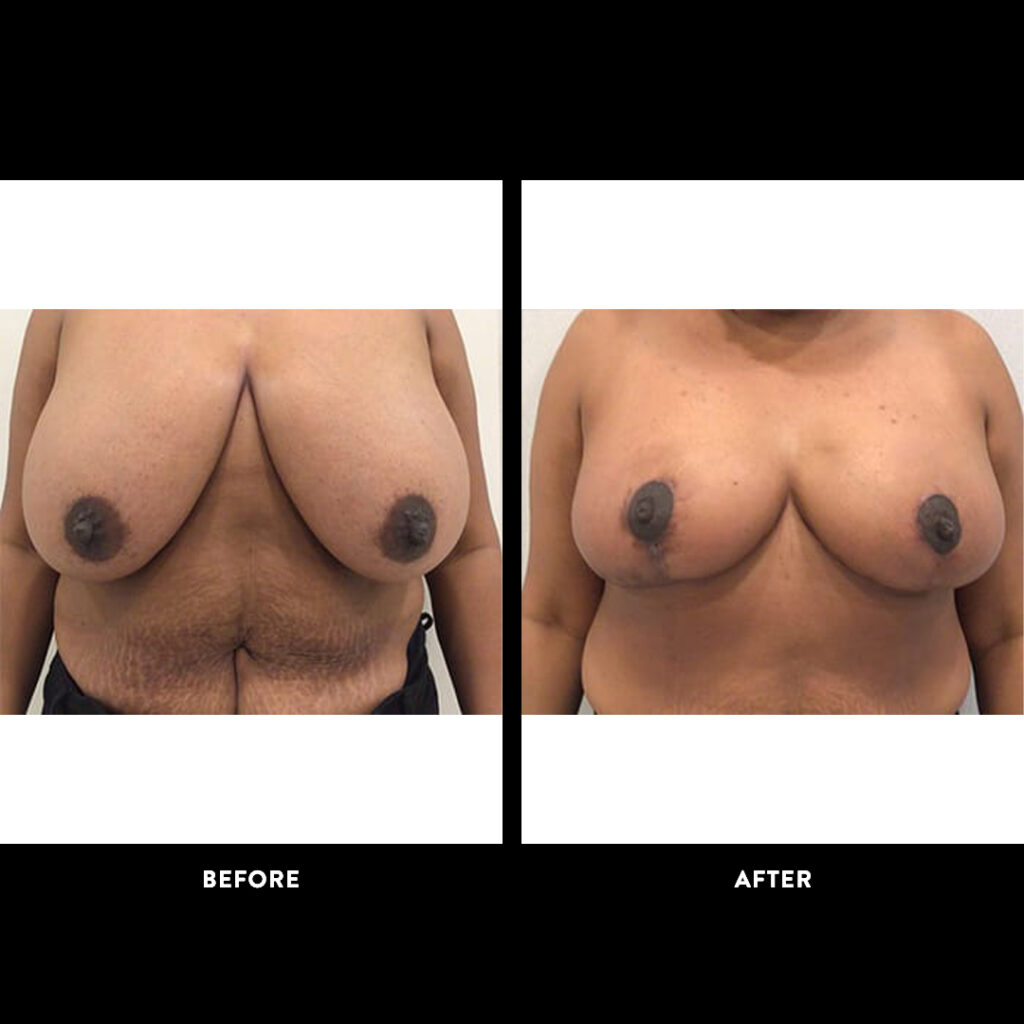 mammaplasty procedure before and after photo