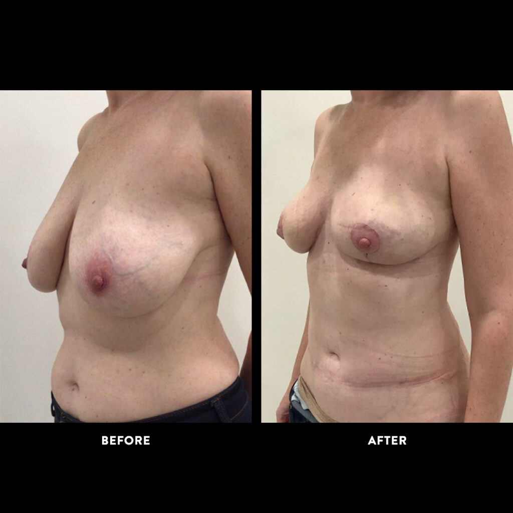 DIEP Flap procedure before & after photo