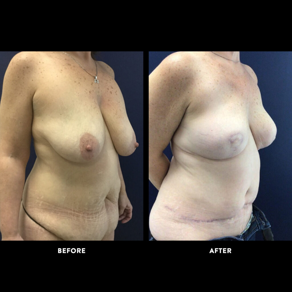 DIEP Flap surgery before & after photo