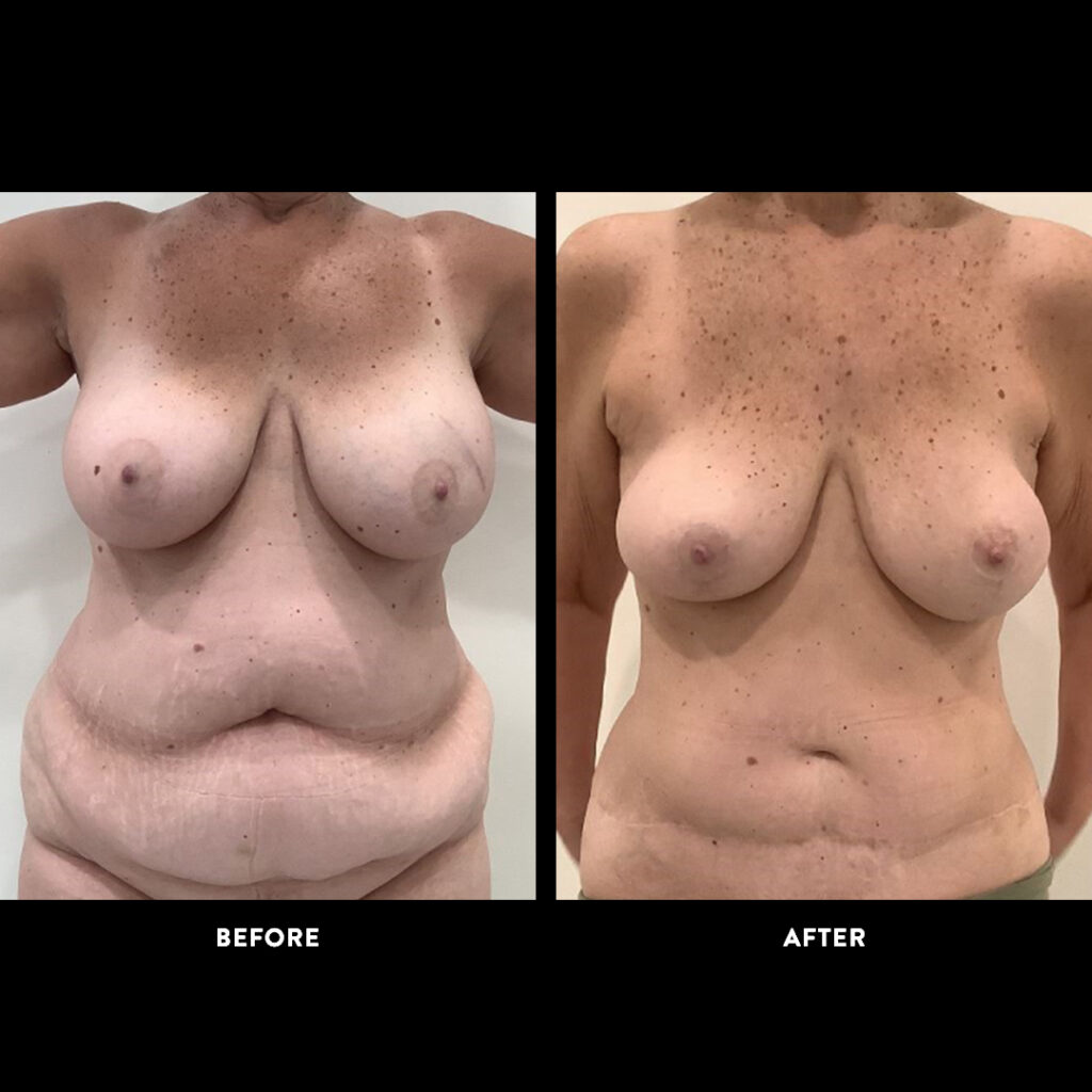 DIEP flap before after