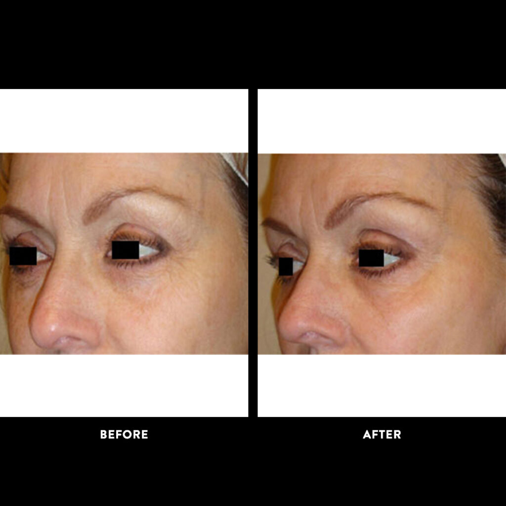 Dermasweep before after picture