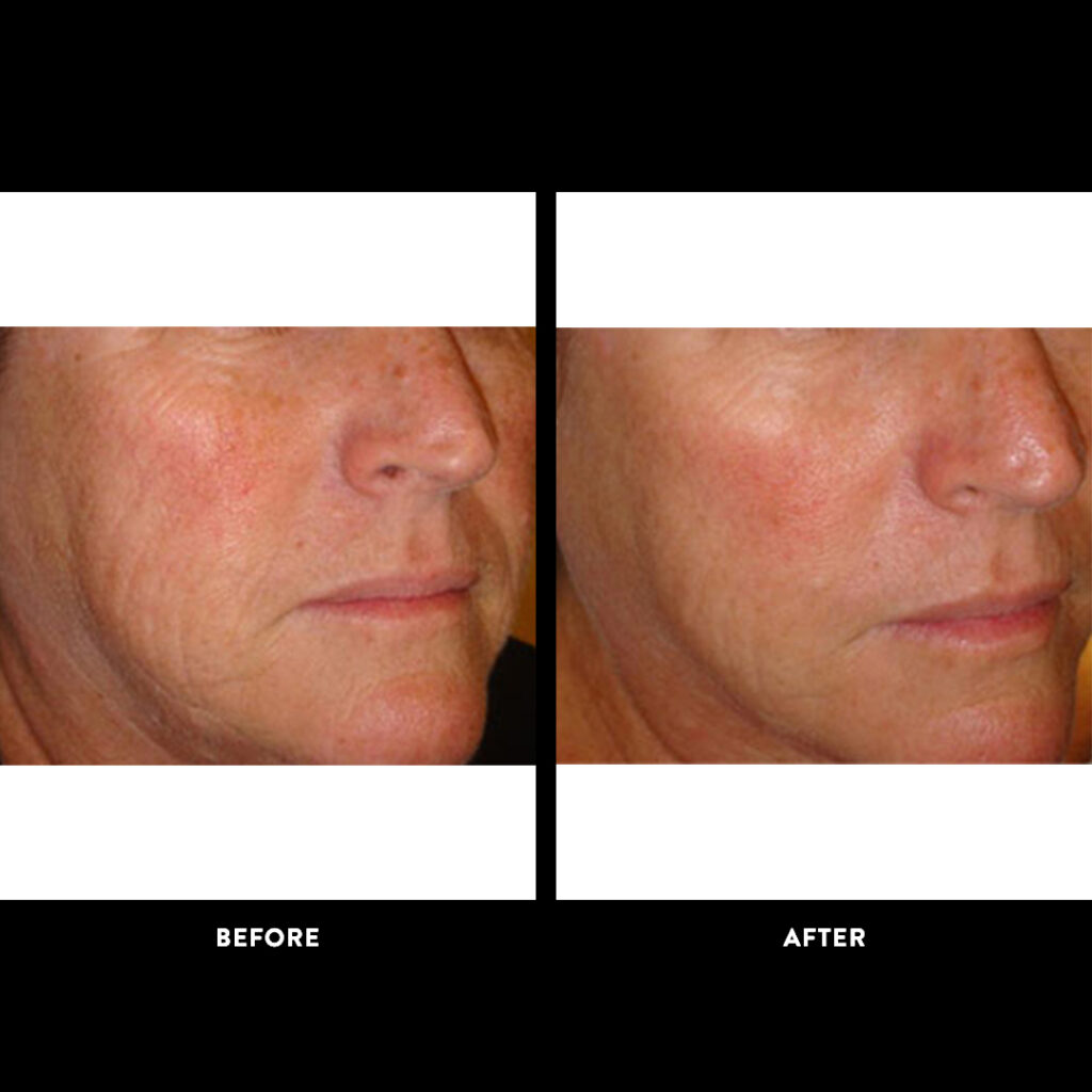 Dermasweep before after
