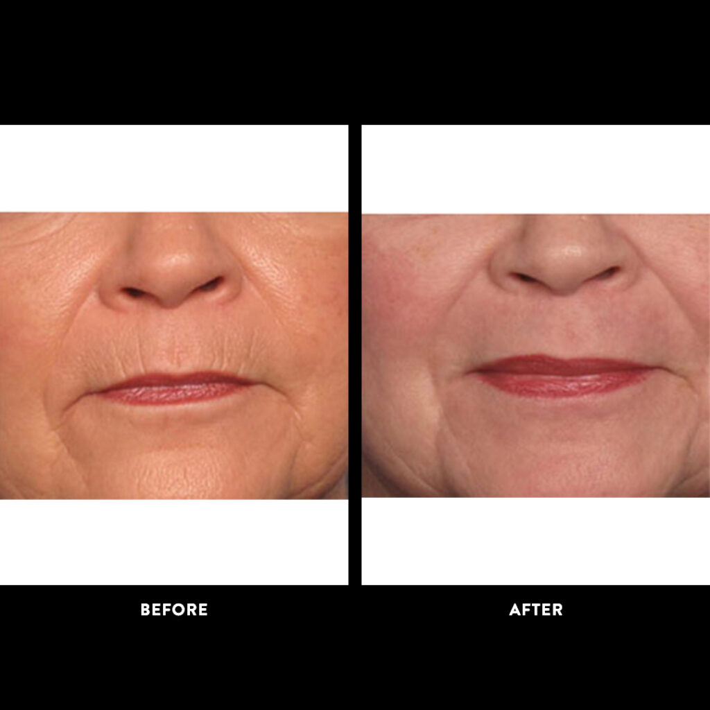 Dermasweep before after photo