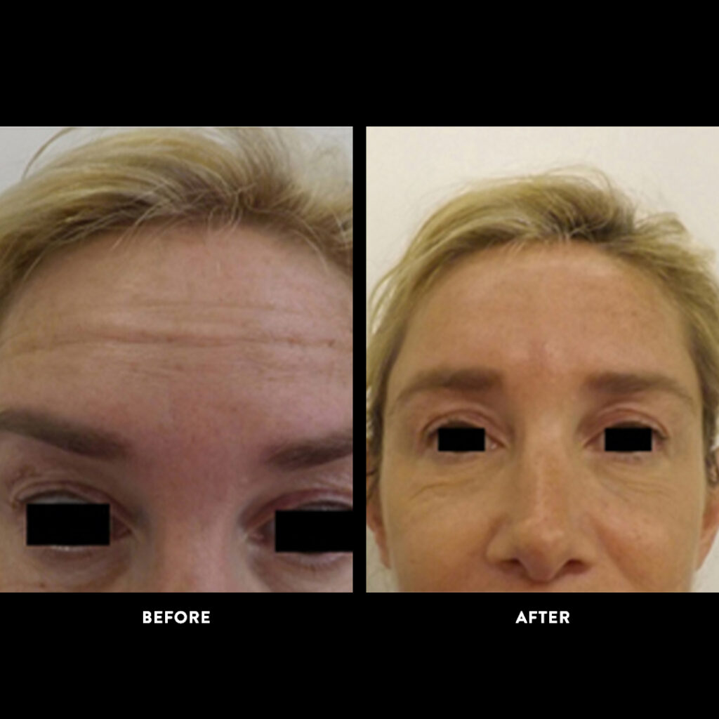 endobrow lift procedure before & after