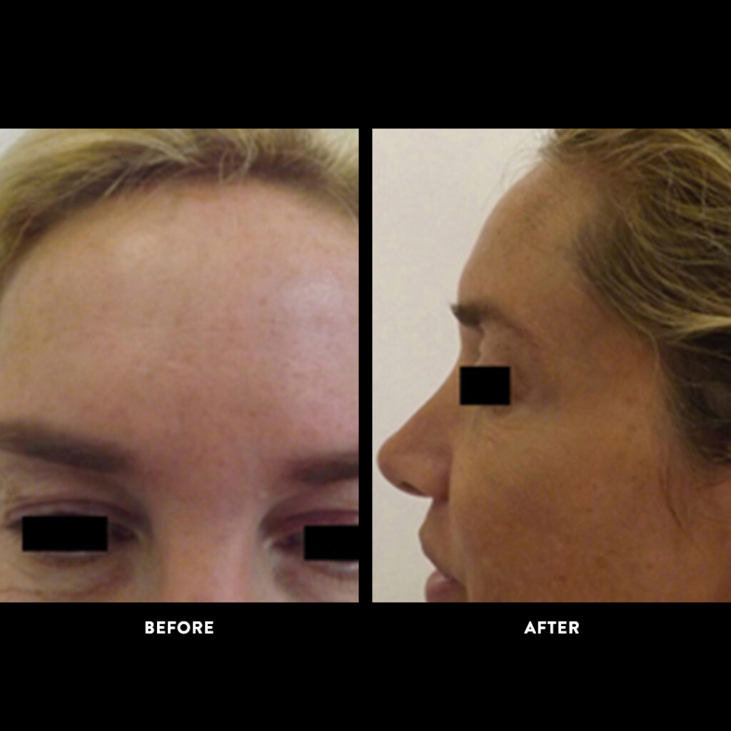 endobrow lift before & after