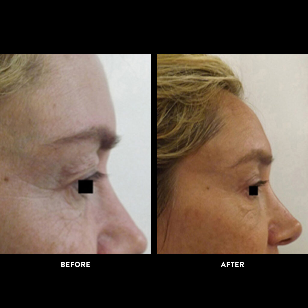 endobrow lift procedure before & after picture
