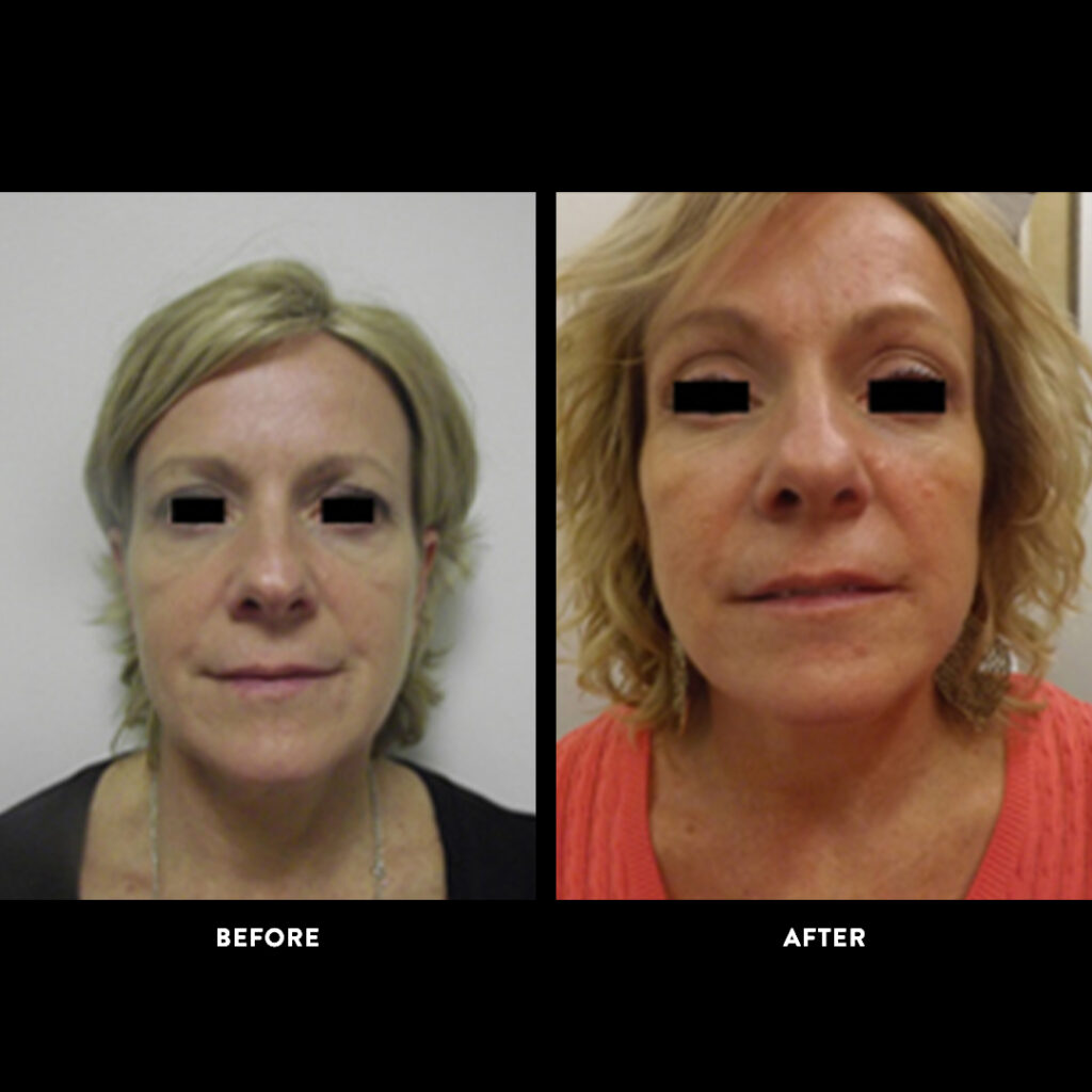 endobrow lift procedure before & after photo