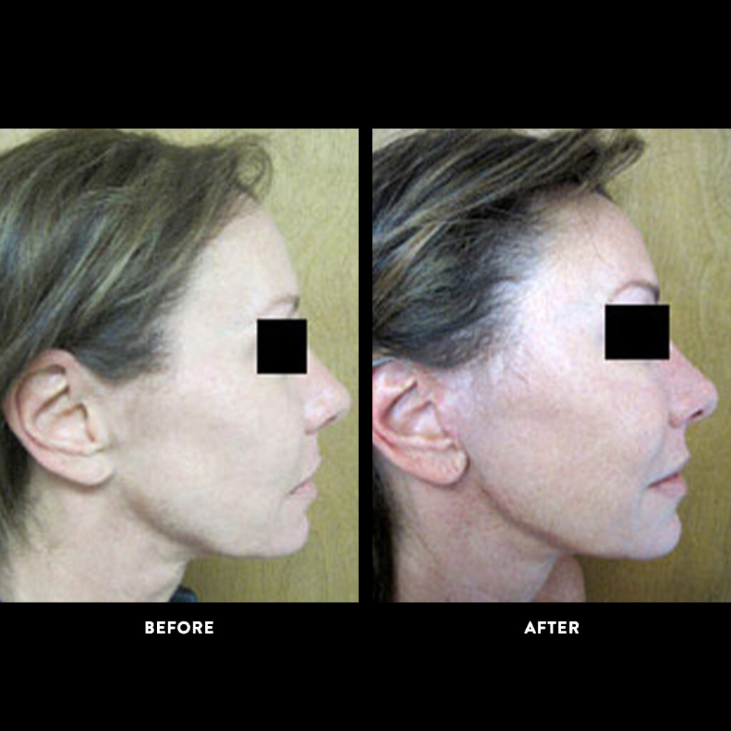 facelift before & after