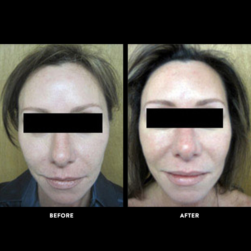 facelift before & after picture