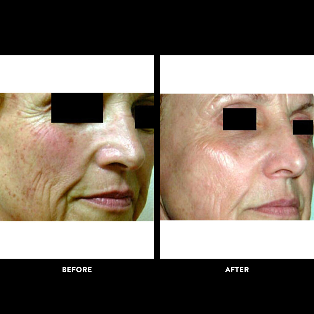 facelift before & after photo