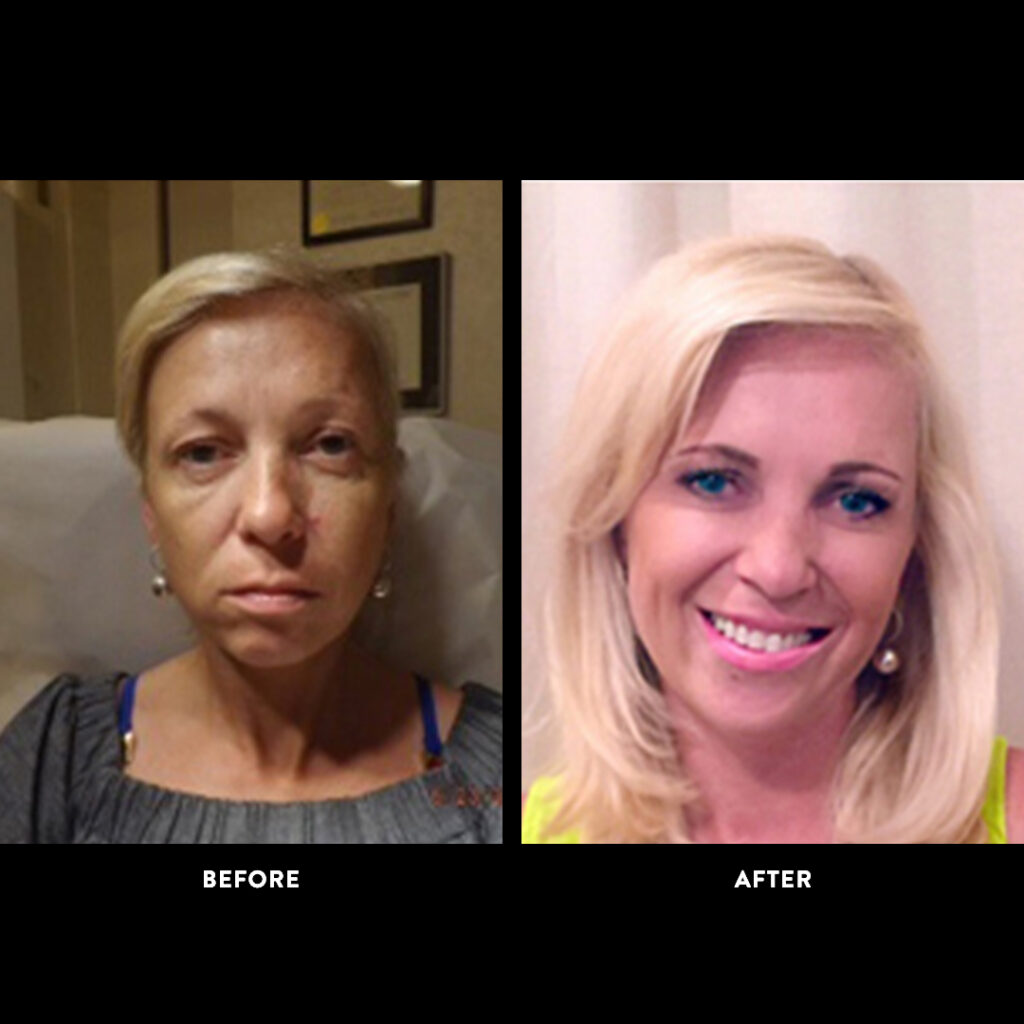 botox & fillers before & after photo