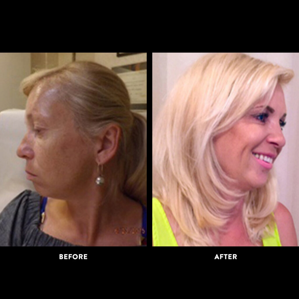 botox & fillers before & after