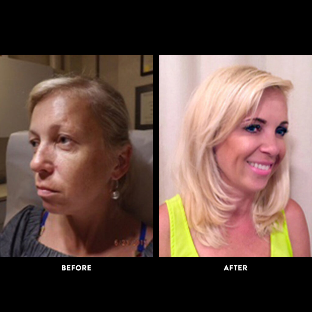 botox & filler injections before & after photo