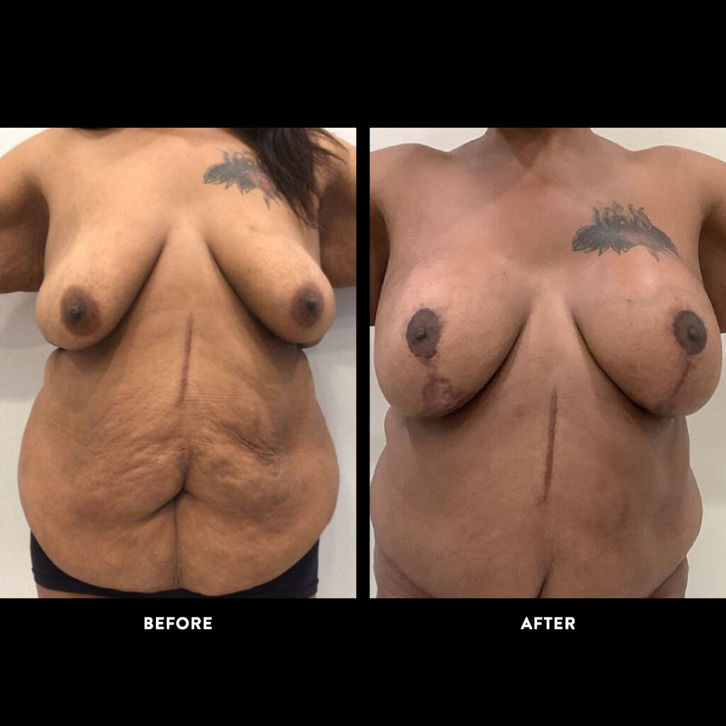 breast procedure before & after