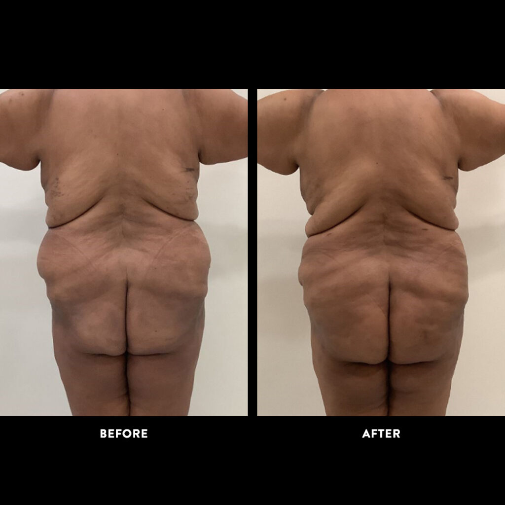 gender affirming procedure before & after photo