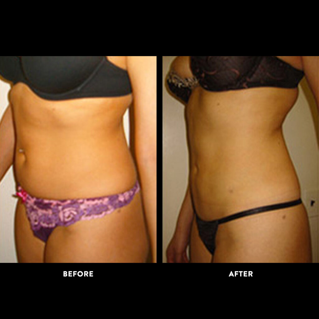 lipo before and after