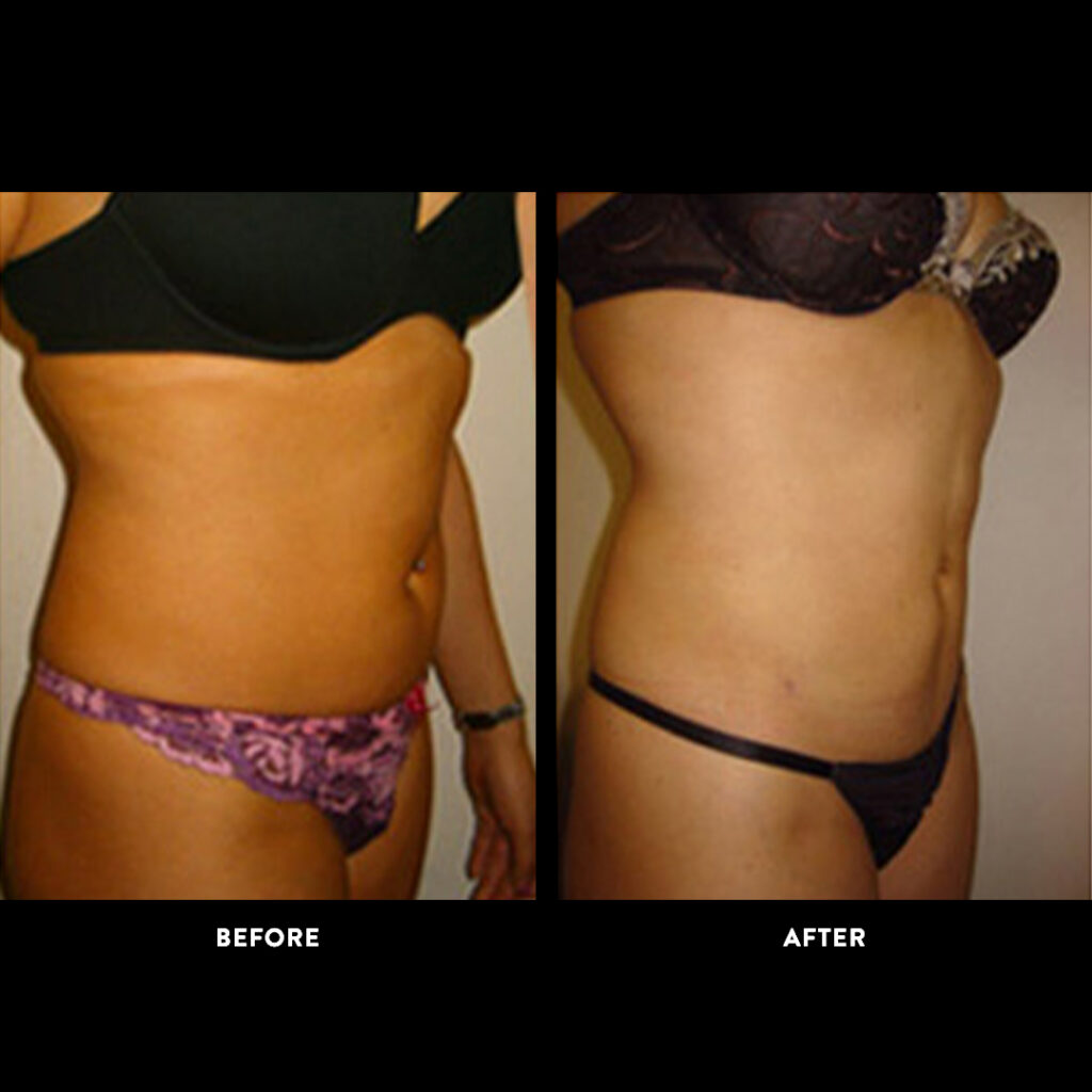 lipo before & after