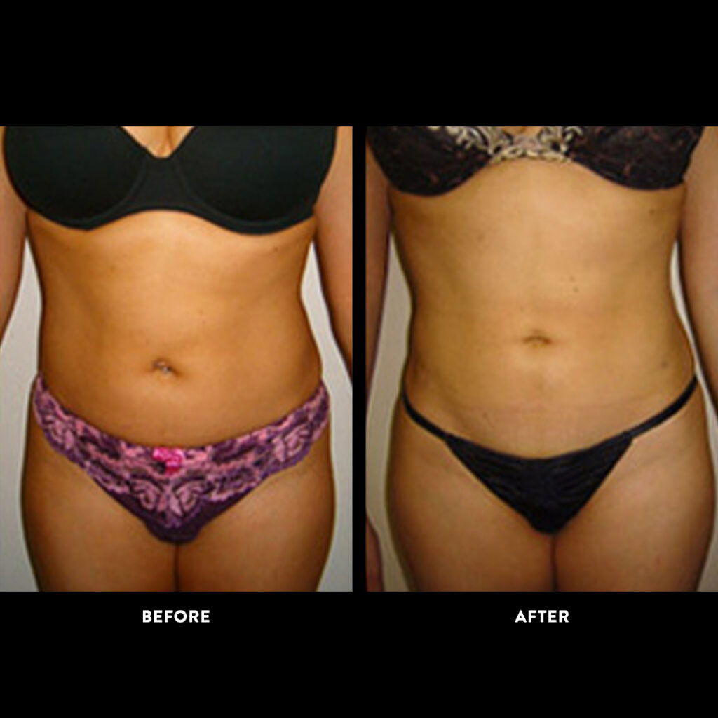 liposuction before & after